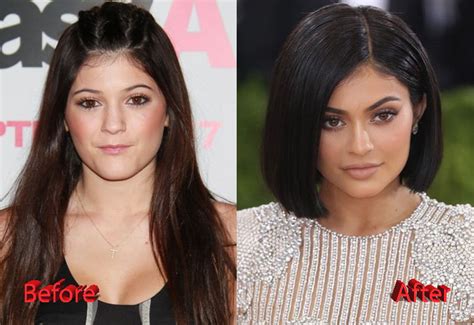 In the controversy of kylie jenner before and after plastic surgery, we have also heard about different rumors on kylie jenner chin surgery after the comparison between her then and now photos. Kylie Jenner Plastic Surgery Facts, Rumors and News