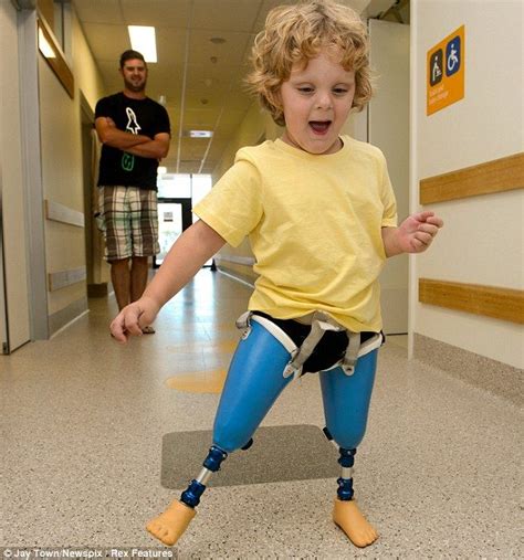 Up And About Three Year Old Ted Johnson Tries Out His New Prosthetic
