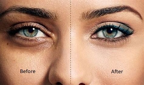 Dark Circles Under Eyes Treatment Zafeerah Skin Clinic
