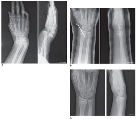 Distal Radius And Carpal Fractures Obgyn Key