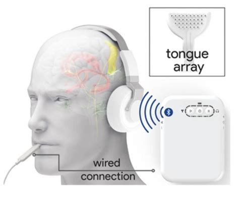Sensory Device Stimulates Ears And Tongue To Treat Tinnitus In Large