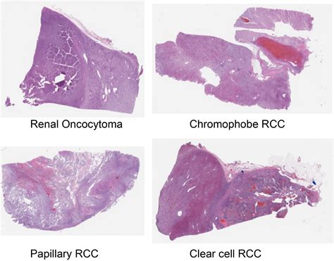 Dartmouth Kidney Cancer Histology Dataset