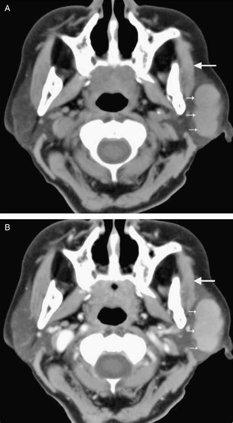 Figure 1 From Tuberculosis Of The Parotid Gland Computed Tomographic
