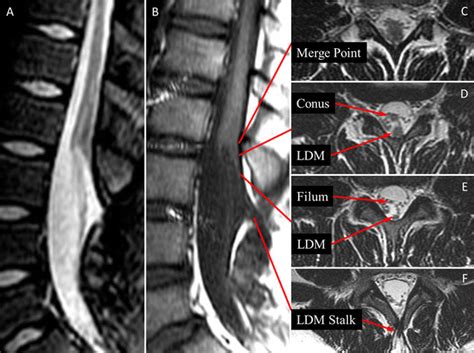 Mri Of Case 1 With A Classic Lumbar Ldm Sagittal T2 Weighted A And