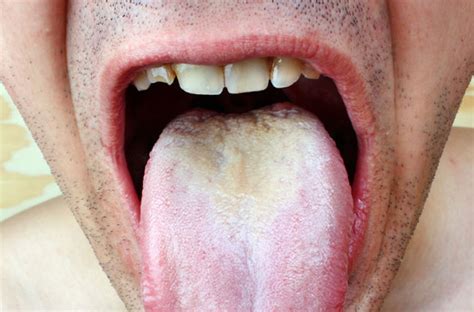 Can Diabetes Cause White Tongue Diabetes Poster