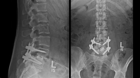 X Ray Of A Spinal Fusion [image] Eurekalert Science News Releases