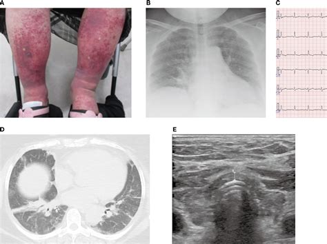 Frontiers Case Report Myxedema Coma Caused By Immunoglobulin A