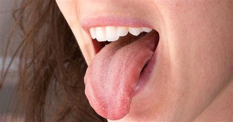 What Is Burning Mouth Syndrome Signs And Symptoms Facty Health