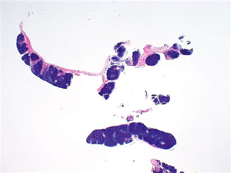 Pathology Outlines Thymoma