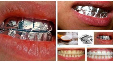 As far as whitening of teeth is concerned i will suggest you following measures : How To Have White Teeth Overnight - TeethWalls