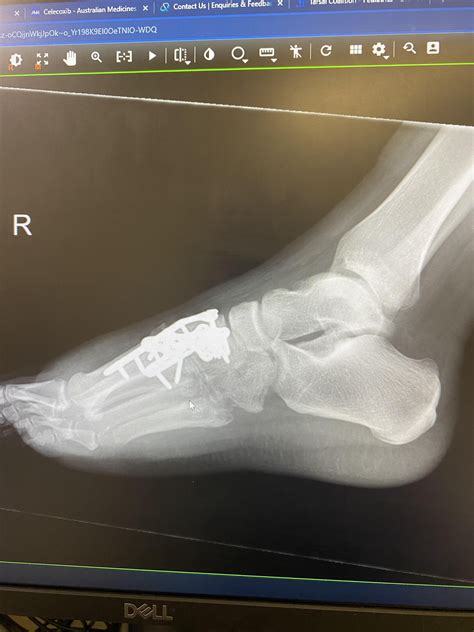 Hi it’s me again :) had my 6wk checkup!! : r/LisfrancClub