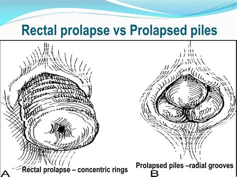 Ppt Rectal Prolapse And Its Laparoscopic Management A Video Presentation Powerpoint