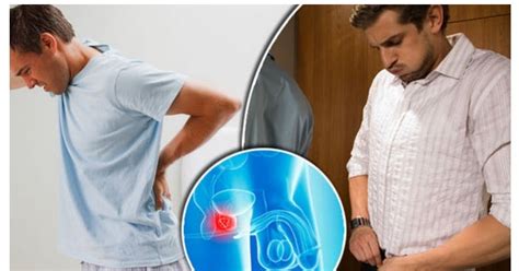 Most Effective Treatment Of Prostate Cancer Back Pain