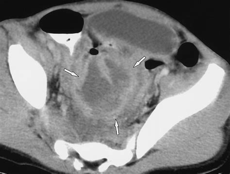 Percutaneous Imaging Guided Abdominal And Pelvic Abscess Drainage In