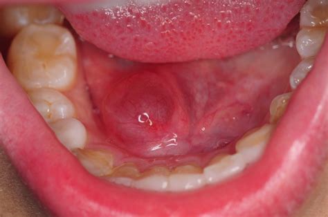 Oral Pathology Jaw Cysts Oral Lesions Ulcers And Others Oral