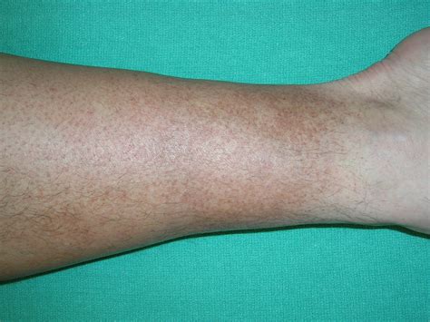 Lymphadema Hemosiderin Staining Legs