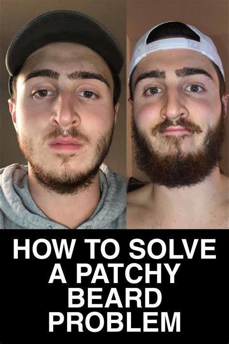how to solve a patchy beard problem