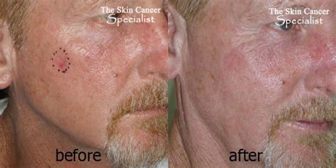 Laser Skin Cancer Therapy Treatment Surgery Dr Peter Kim Dr Peter Kim