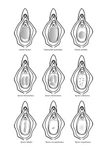 Diagram Of A Vagina Hymen Telegraph