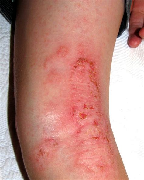 Eczema Behind Knee Flickr Photo Sharing