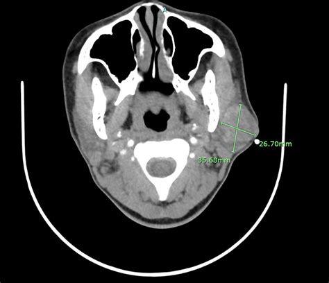 Cureus A Diagnostically Challenging Parotid Gland Tumor With Hybrid