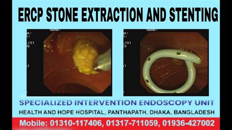 Ercp Stone Extraction And Stenting Dr Masfique Ahmed Bhuiyanfcps Best
