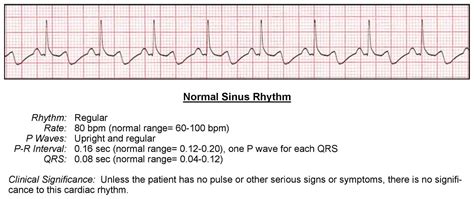 Ecg Of Normal Sinus Rhythm