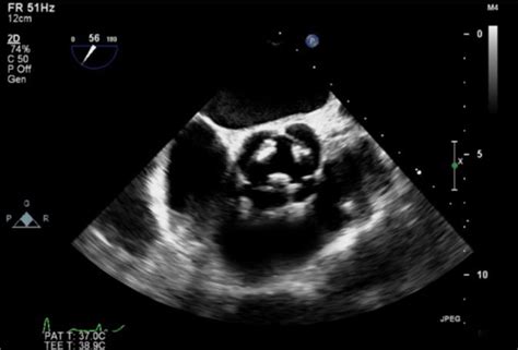 Type F Congenital Quadricuspid Aortic Valve A Very Rare Case Diagnosed