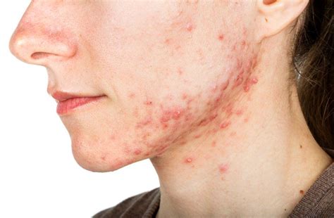 Are You Equipped To Identify Depression In Your Acne Patient