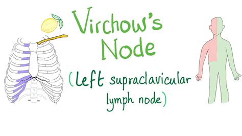 Virchows Node Left Supraclavicular Lymph Node Youtube
