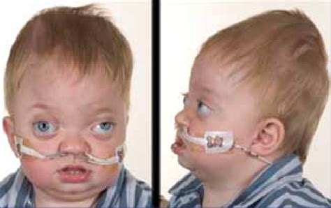 Showing The Characteristic Features Of A Patient With Crouzon Syndrome