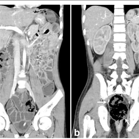 Contrast Enhanced Abdominal Computed Tomography Ct Emergency Ct