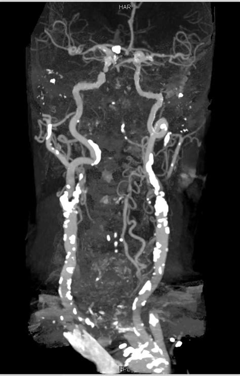 Extensive Carotid Artery Disease Neuro Case Studies Ctisus Ct Scanning