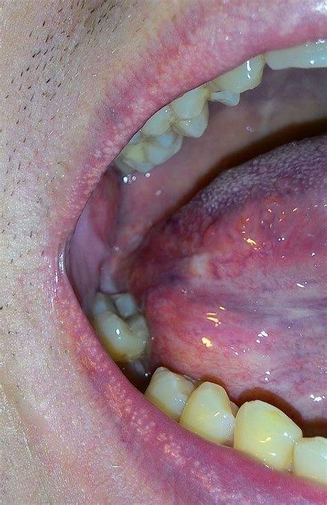 Red Bumps On The Side Of The Tongue Dentistry Forums