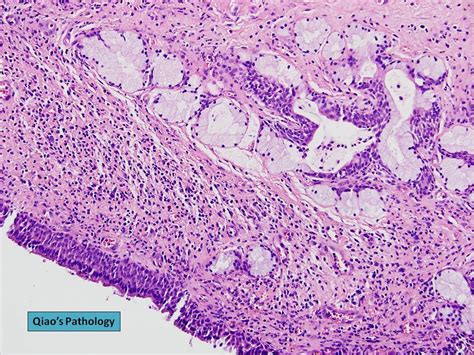 Qiao S Pathology Bartholin S Cyst Of Vulva A Photo On Flickriver