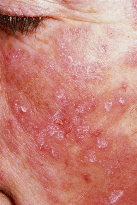Rash Of Systemic Lupus Erythematosus On Cheek Stock Image M2000017