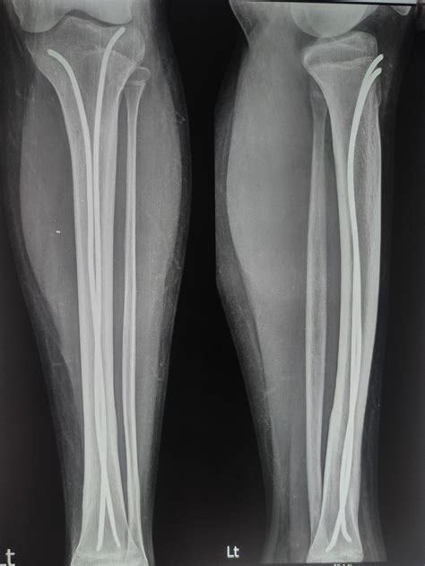 Pediatric Leg Fracture Tibia And Fibula That Ortho Doctor