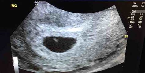 6 Week 1 Day Ultrasound 13mm Sac No Fetal Pole No Yolk Sac Could It