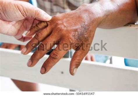 Wound On Skin Heals Crusts Human Stock Photo Edit Now 1041691147
