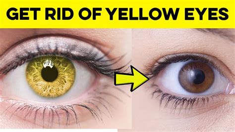 How To Get Rid Of Yellow Eyes Best Home Remedies For Yellow Eyes
