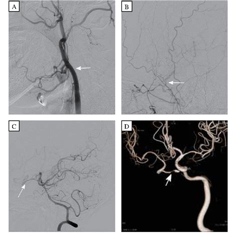 Figure From Internal Carotid Artery Agenesis With Stenosed Intercavernous Anastomosis A Case