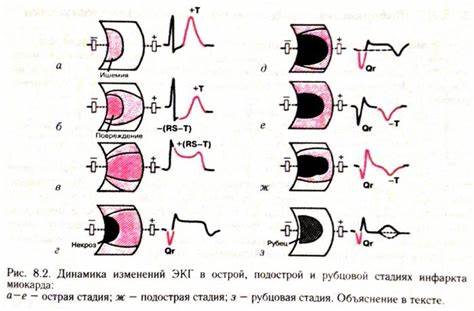 Диета при ишемии миокарда ЭКГ при инфаркте миокарда (фото с расшифровкой), кардиограмма, инфаркт ЭКГ при инфаркте миокарда (фото с расшифровкой), кардиограмма, инфаркт Диета при ишемии миокарда