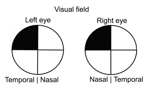 Re Visual Impairment The Bmj