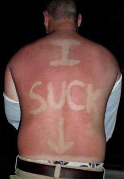 Upbeat News These Sunburn Fails Hurt Just To Look At