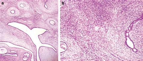 A Rare Case Of A Phyllodes Tumour Of The Breast Converting To A