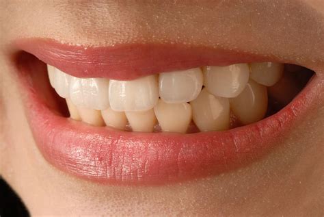 What Are Veneers For Teeth Types Procedure And Cost