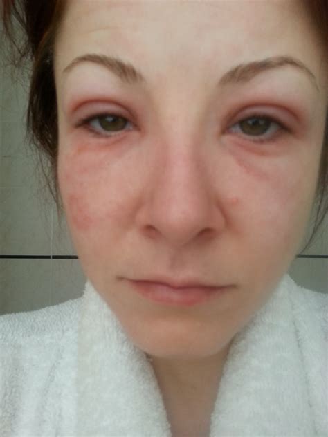 The Fear Of The Swollen Face An Allergic Reaction To What Whoopee