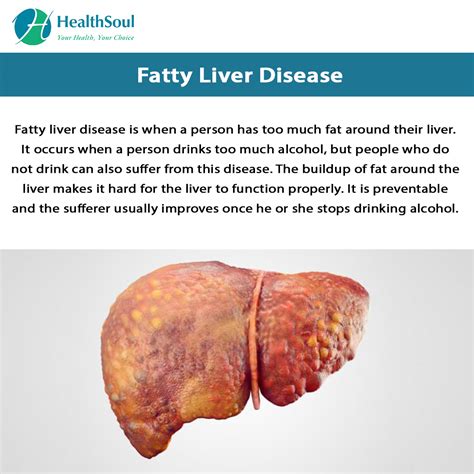 Non Alcoholic Fatty Liver Disease Causes Symptoms And Treatments