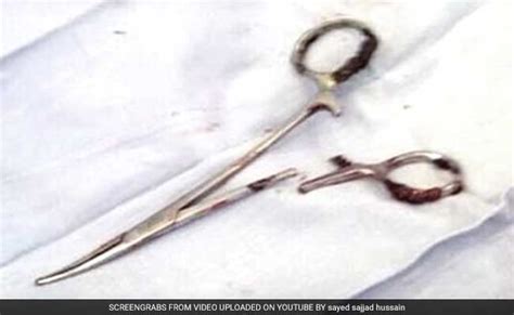 Scissors Pulled From Mans Stomach 18 Years After Surgery