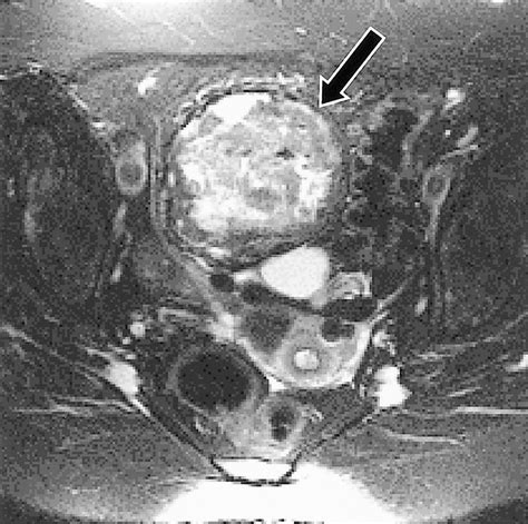 Ovarian Teratomas Tumor Types And Imaging Characteristics Radiographics